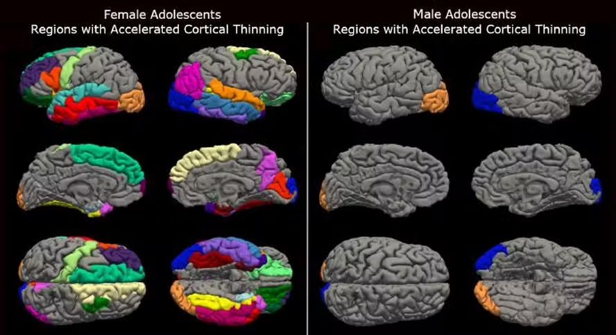 Estudo mostra como a pandemia pode ter afetado o cérebro de adolescentes - Foto: Institute for Learning and Brain Sciences, University of Washington/The New York Times