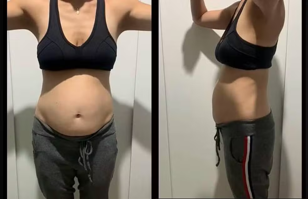 Diástase abdominal: entenda a condição que faz a barriga das mulheres aumentar — Foto: Arquivo Pessoal